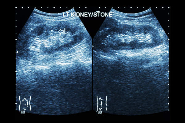 肾脏超音波显示左肾结石