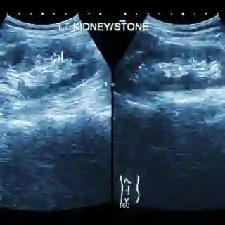 Ultrasonography of kidney, showing left kidney stone