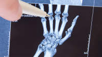 人手的x射线图像。