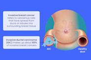 Invasive Ductal Carcinoma New Study Reveals Late Spread Of Breast Invasive Ductal Carcinoma New Study Reveals Late Spread Of Breast