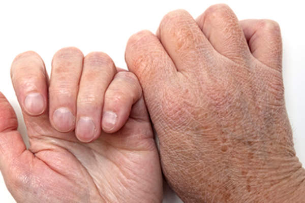 干裂的手的皮肤。