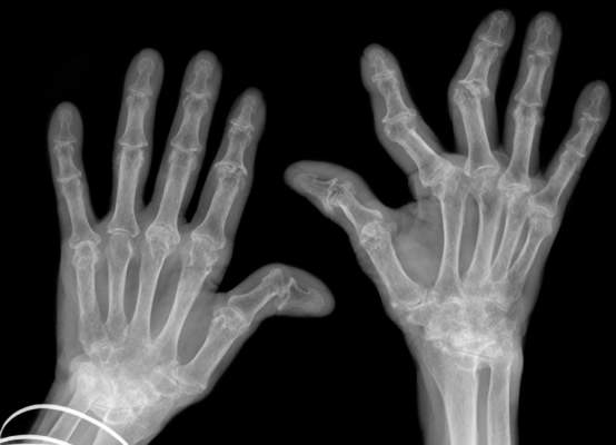 手部x光片显示晚期类风湿关节炎