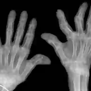 Hand xrays showing advanced rheumatoid arthritis