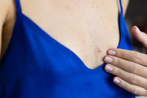 Pimples on Breasts: Causes, Treatment, When to See a Doctor