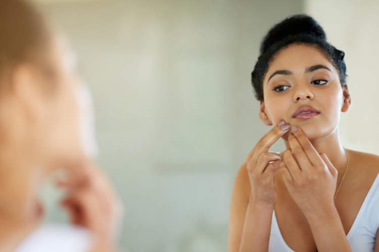 一个女人的外表在她周围的下巴痘痘镜子。痤疮是PCOS的一个标志。