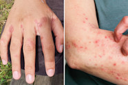 Scabies Rash Photos Scabies Rash Photos