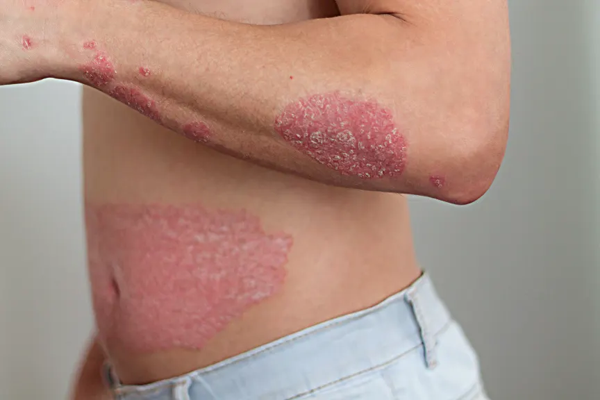 psoriasis scale removal