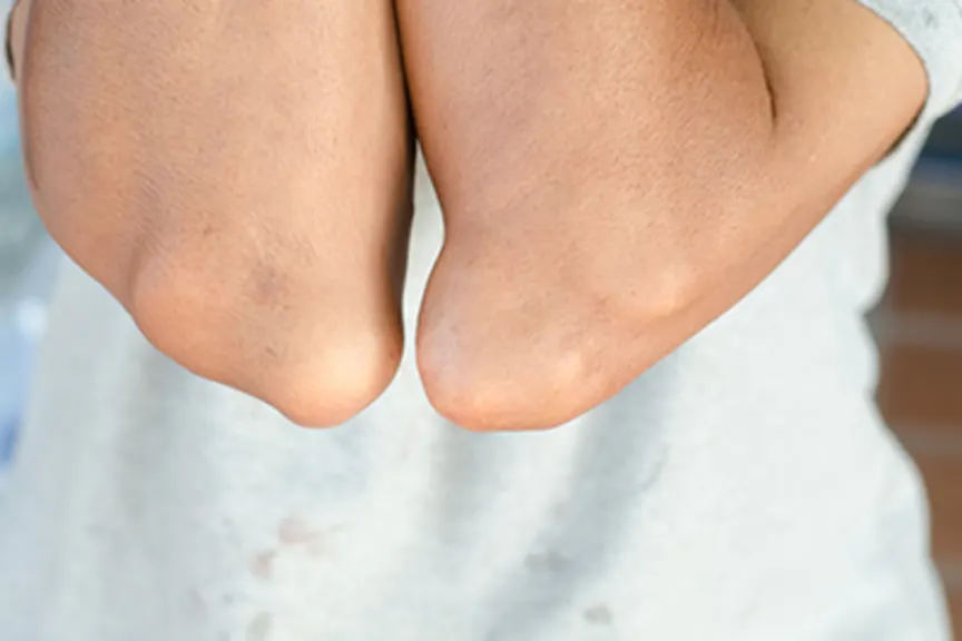 Elbows of a gout patient.