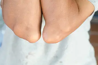 因痛风而肿胀的肘部