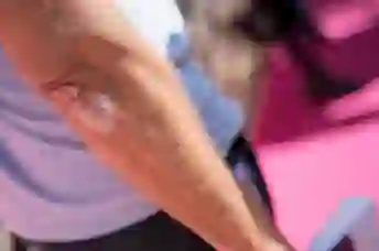 肘部牛皮癣的视图