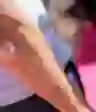 肘部牛皮癣的视图