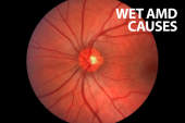 Wet AMD Causes