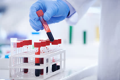 血液小瓶类风湿因子与抗CCP抗体测试。