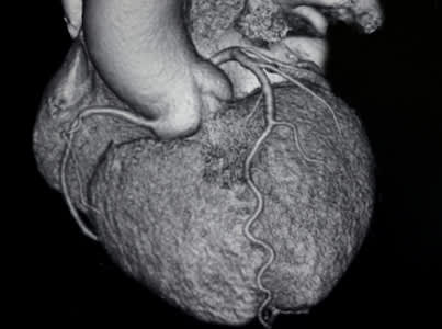 心脏CT图像