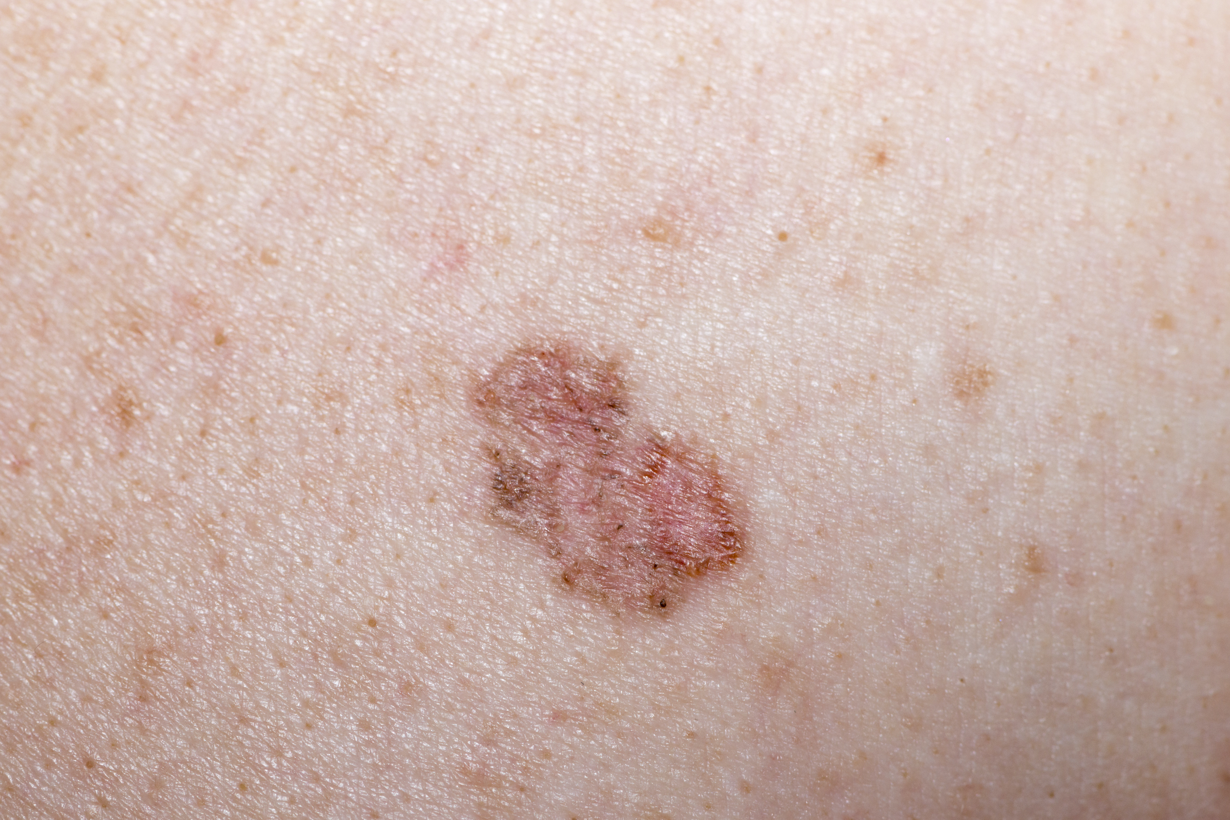 6 Kinds of Skin Cancer and Their Symptoms