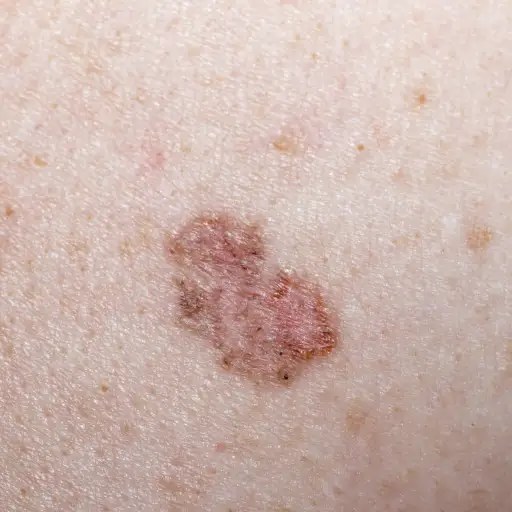 warts on skin or skin cancer