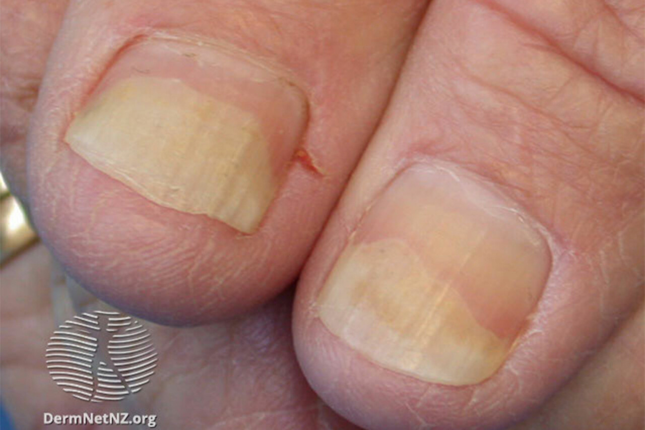 Overgrown Cuticles: Causes, Treatment, and Prevention