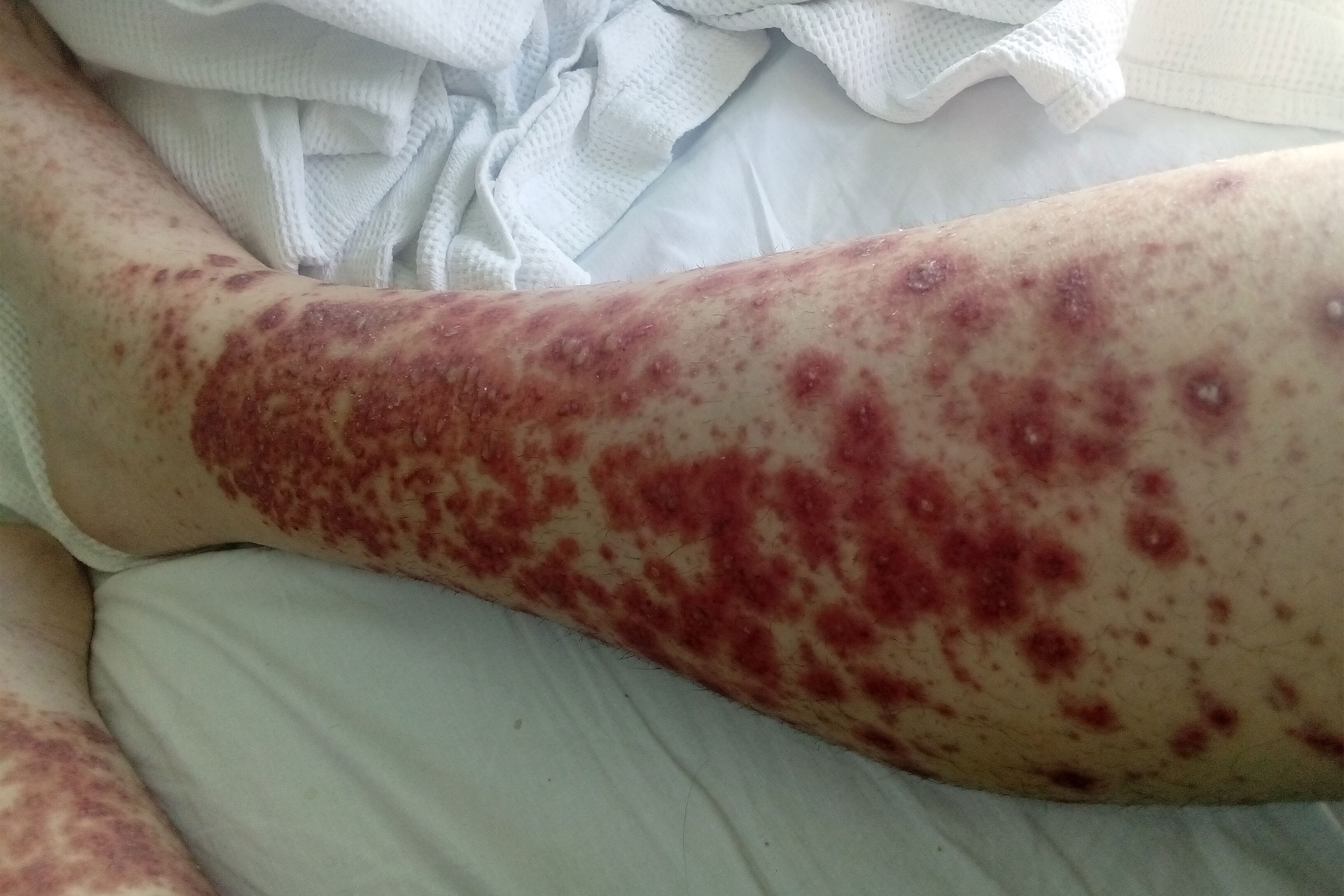 Small White spots surrounded by redness usually alone sometimes in groups  of three red spots nearby. : r/Dermatology