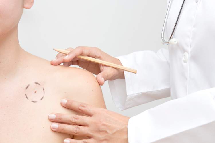 黑色素瘤盘旋了手术。