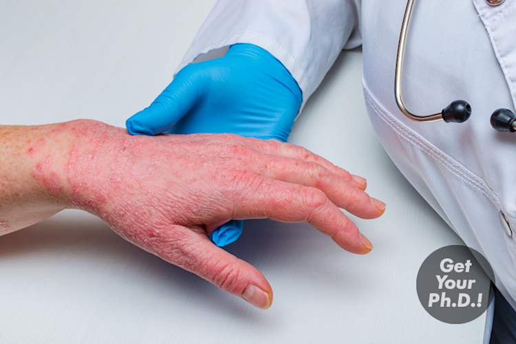 牛皮癣研究与贴纸