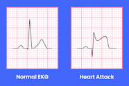 Normal Ecg Vs Heart Attack Ecg ECG Basics Video Causes Meaning