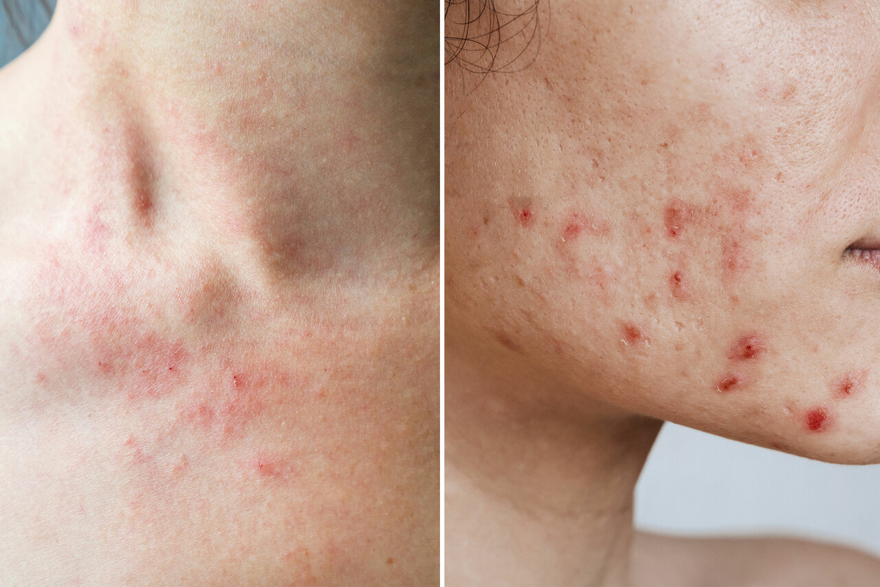 Eczema vs. Acne: What's the Difference?, image size:1280x853