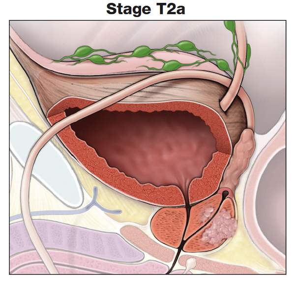 理解前列腺癌肿瘤分期- t2a -前列腺