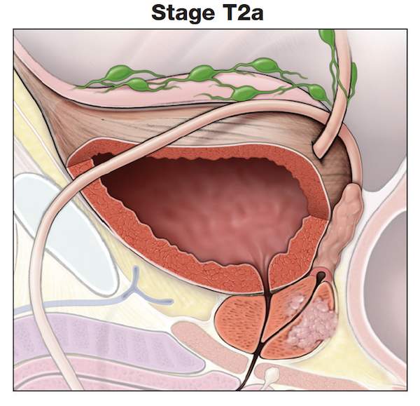 理解前列腺癌肿瘤分期- t2a -前列腺