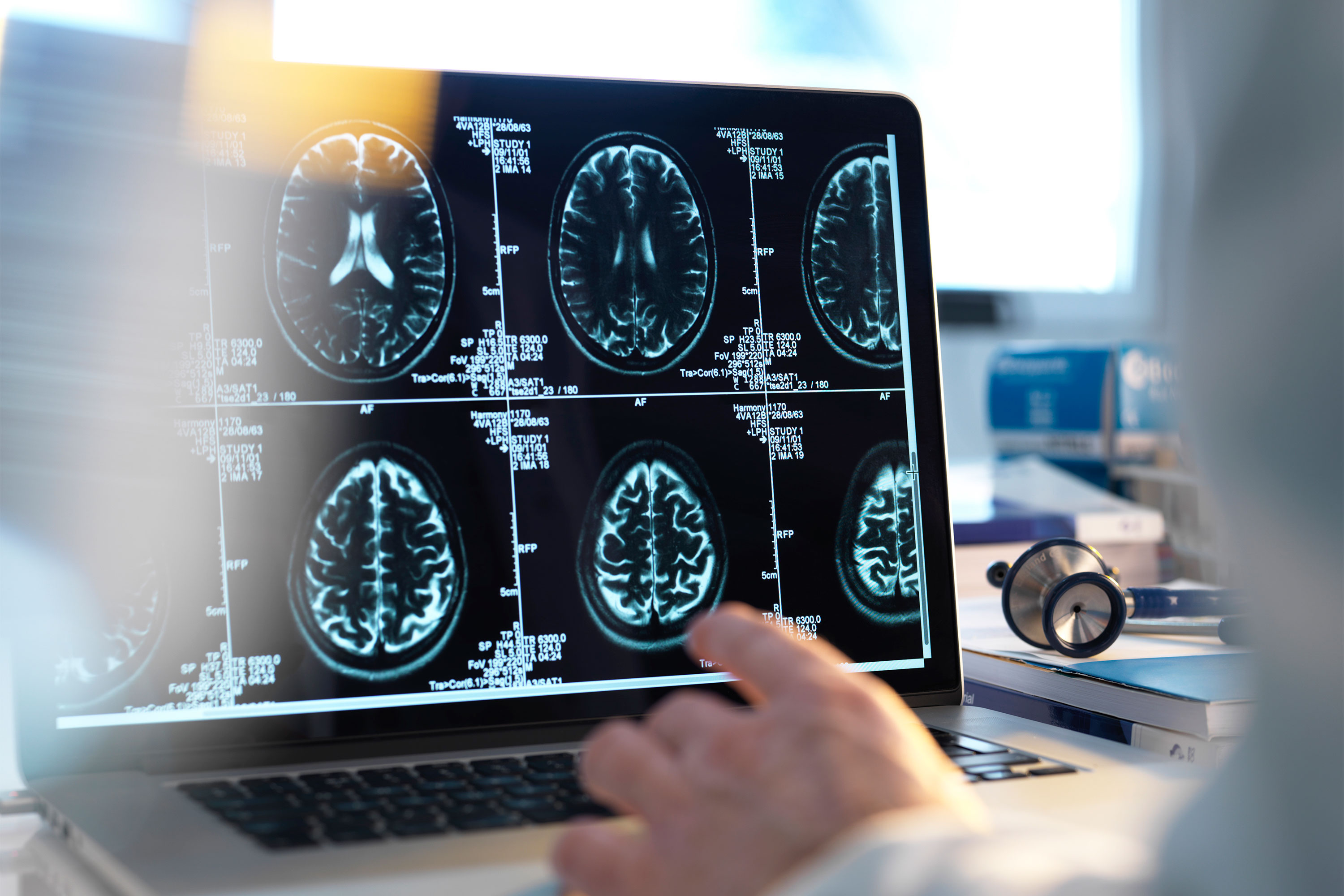 What is Clinically Isolated Syndrome and How is It Linked to MS?