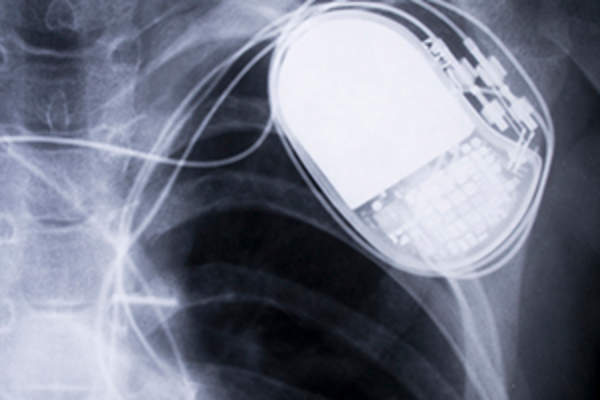 植入式起搏器图像