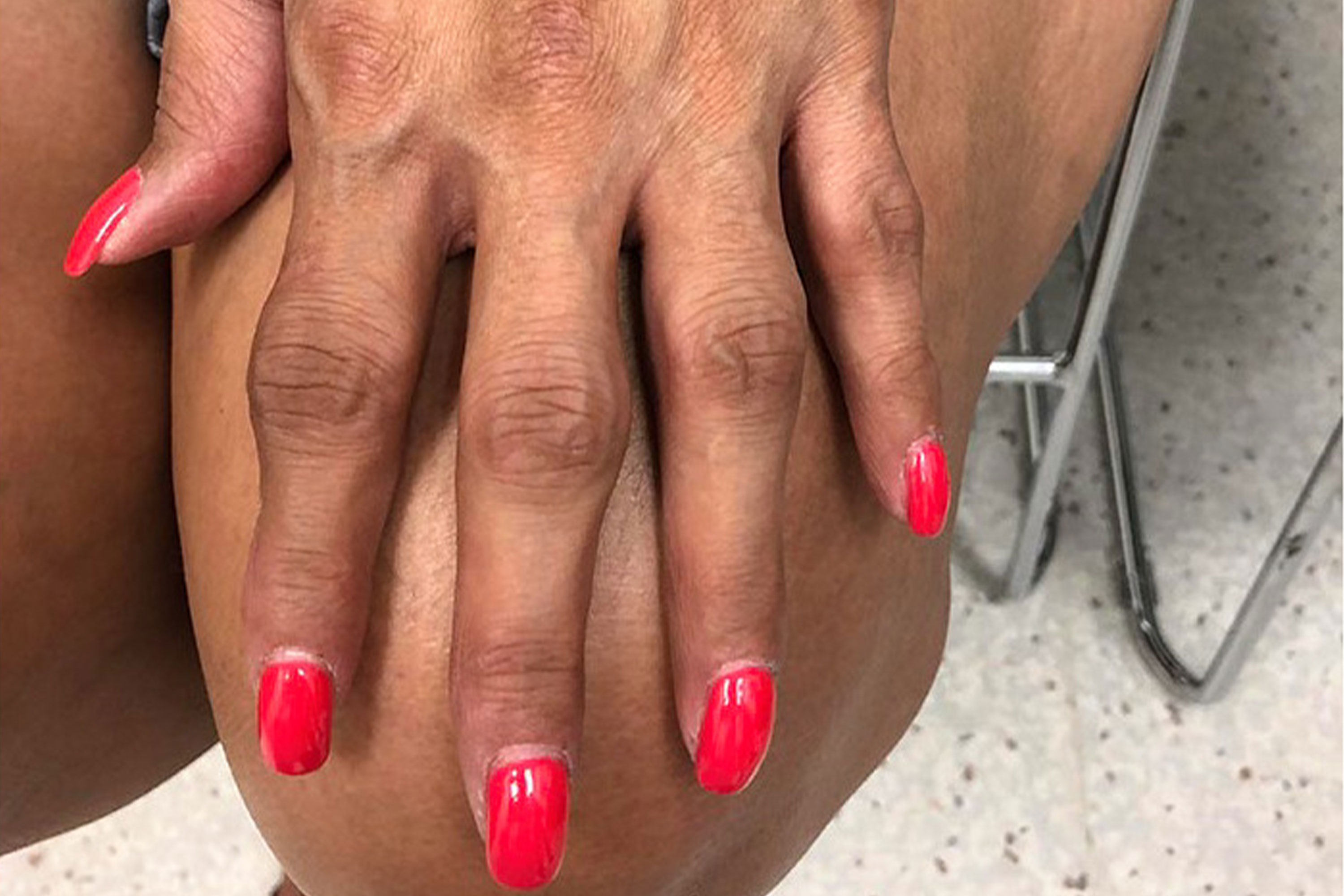 Nail pitting !! - September 2019 Babies | Forums | What to Expect