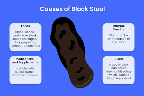 What Causes Black or Tarry Stool?