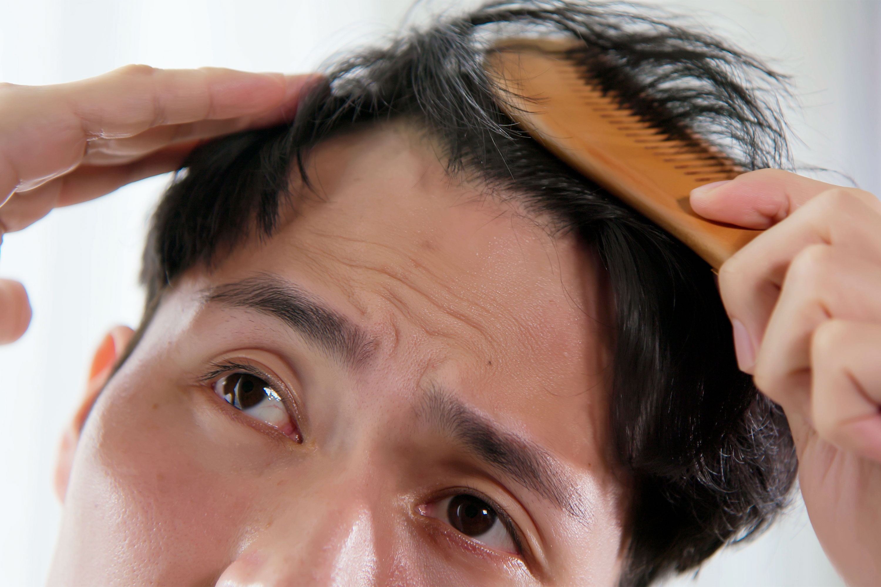 Top 10 Facts on Hair Loss