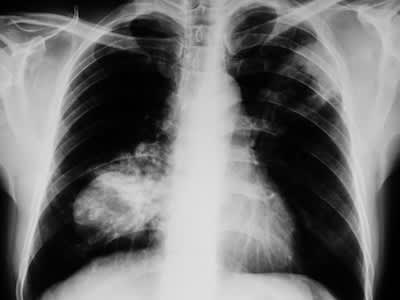 癌性肺的x光片。