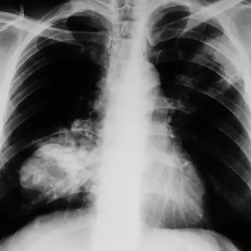 癌症肺的X射线。