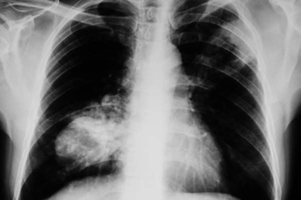 癌性肺的x光片。
