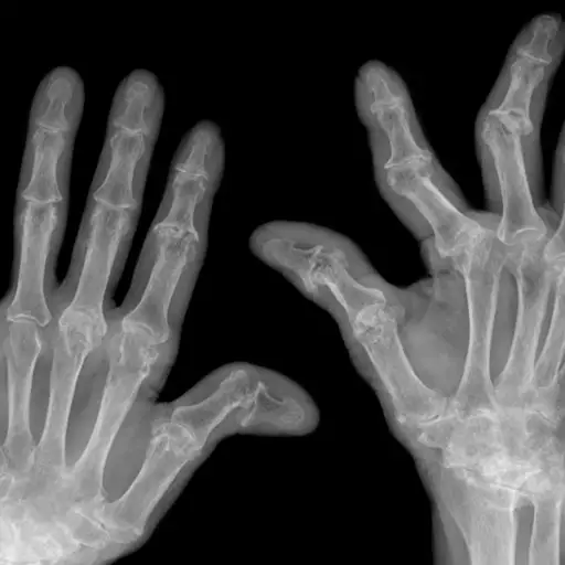 手部x光显示类风湿关节炎晚期