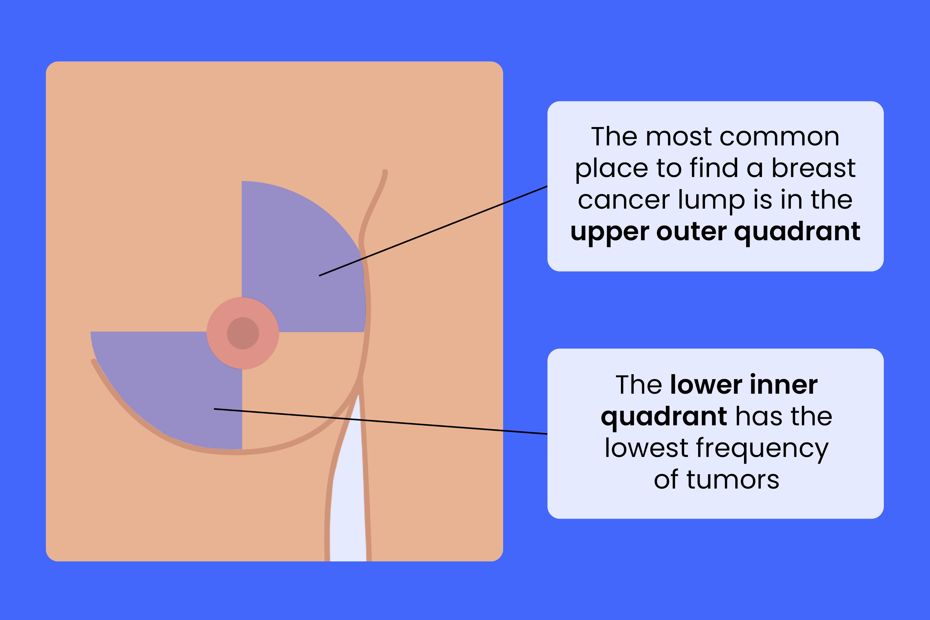 The image is an informational graphic illustrating the common locations for breast cancer lumps to develop. It features a simplified, cartoon-style depiction of a female torso and breast, rendered in shades of beige and light blue. A large, circular, reddish-orange area highlights a potential lump within the upper outer quadrant of the breast, with a line extending from this area to emphasize its location. This quadrant is visually divided by intersecting lines creating four quadrants within the breast. The image also includes two text boxes with light blue backgrounds. The first text box states, 'The most common place to find a breast cancer lump is in the upper outer quadrant,' directly referencing the highlighted area in the breast illustration. The second text box reads, 'The lower inner quadrant has the lowest frequency of tumors,' indicating a less common location for breast cancer development. The overall design is clean and straightforward, aiming to educate viewers about breast anatomy and potential areas for self-examination or medical attention. The style is illustrative rather than realistic, prioritizing clarity and ease of understanding over anatomical precision. The background is a solid, deep blue color, providing contrast and making the information stand out. The image is designed to be easily digestible and informative for a general audience.