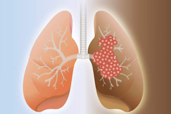 健康的肺和癌症的肺是一个例证