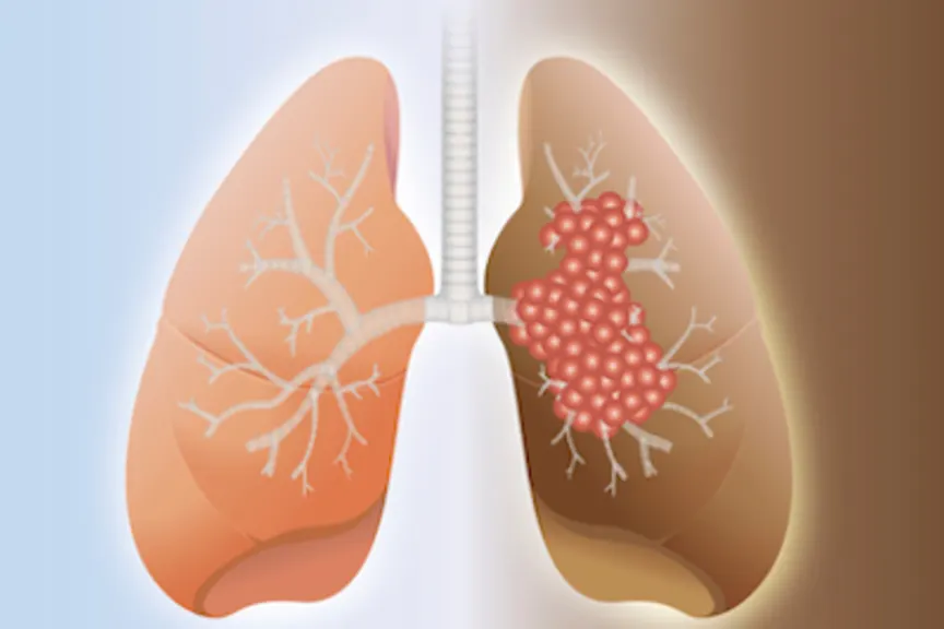 健康的肺和癌症肺一个例证