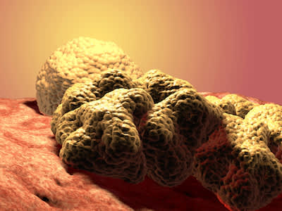 生长肿瘤细胞瘤，医疗图示。