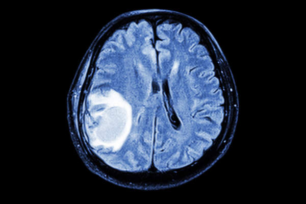 MRI扫描脑部有肿瘤转移