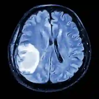 MRI scan of brain with metastatic tumor