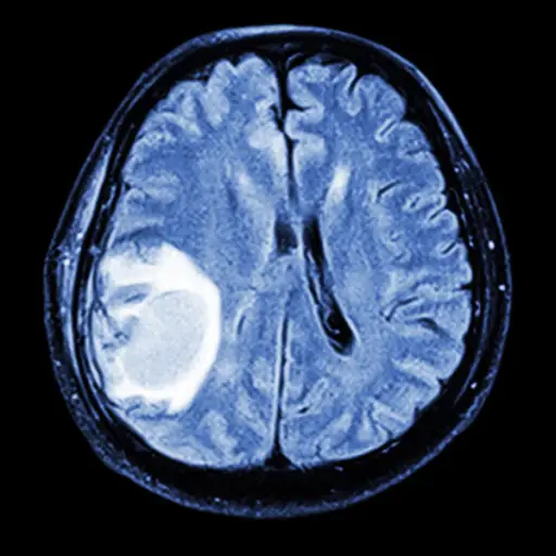 大脑的MRI扫描转移性肿瘤