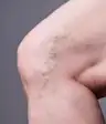 varicose veins