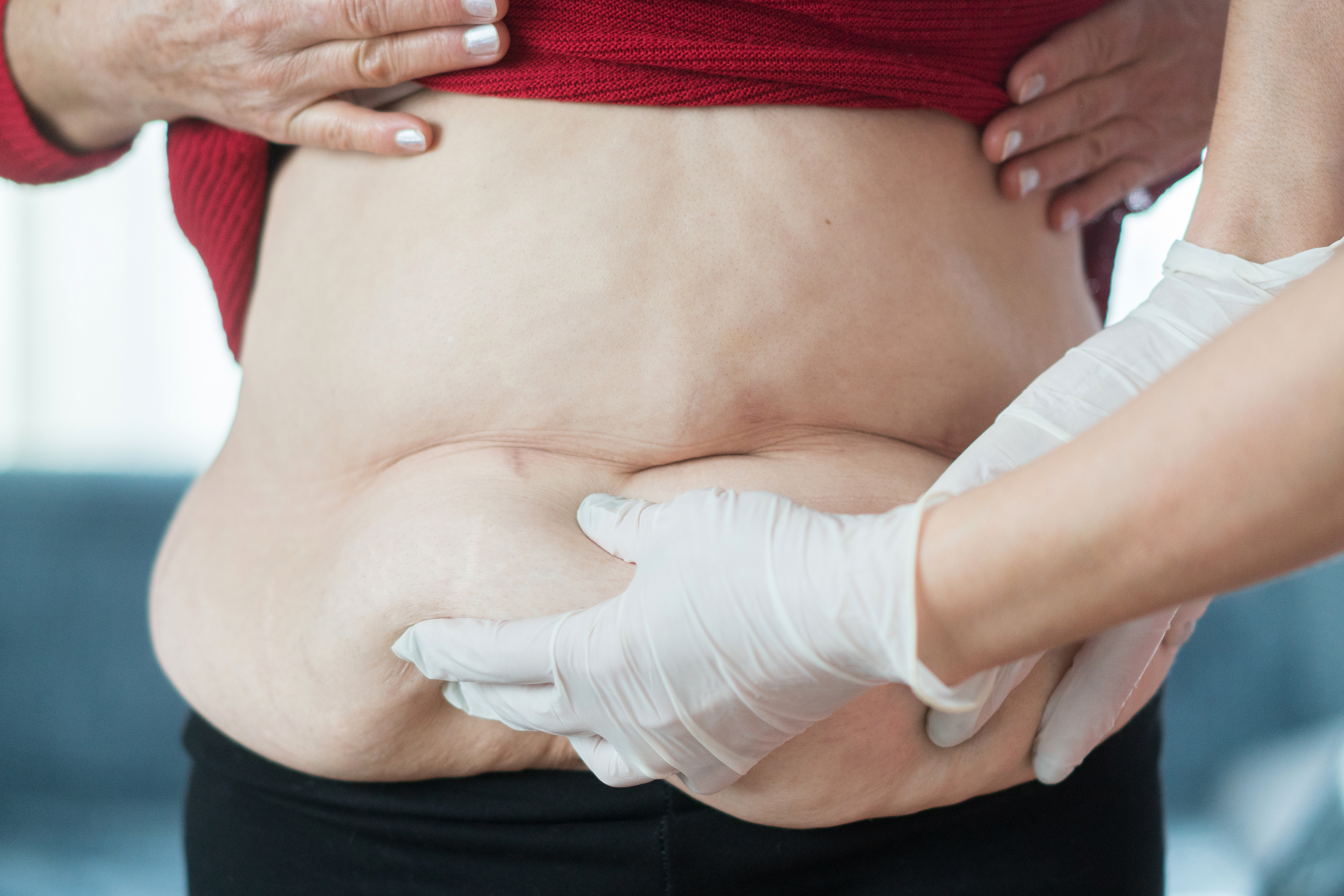 Am I A Good Candidate For An Abdominal Panniculectomy At My Current Weight?  - Plastic Surgeon