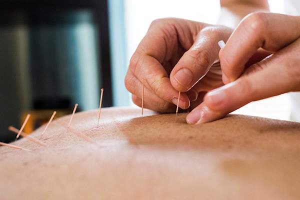 针灸治疗。