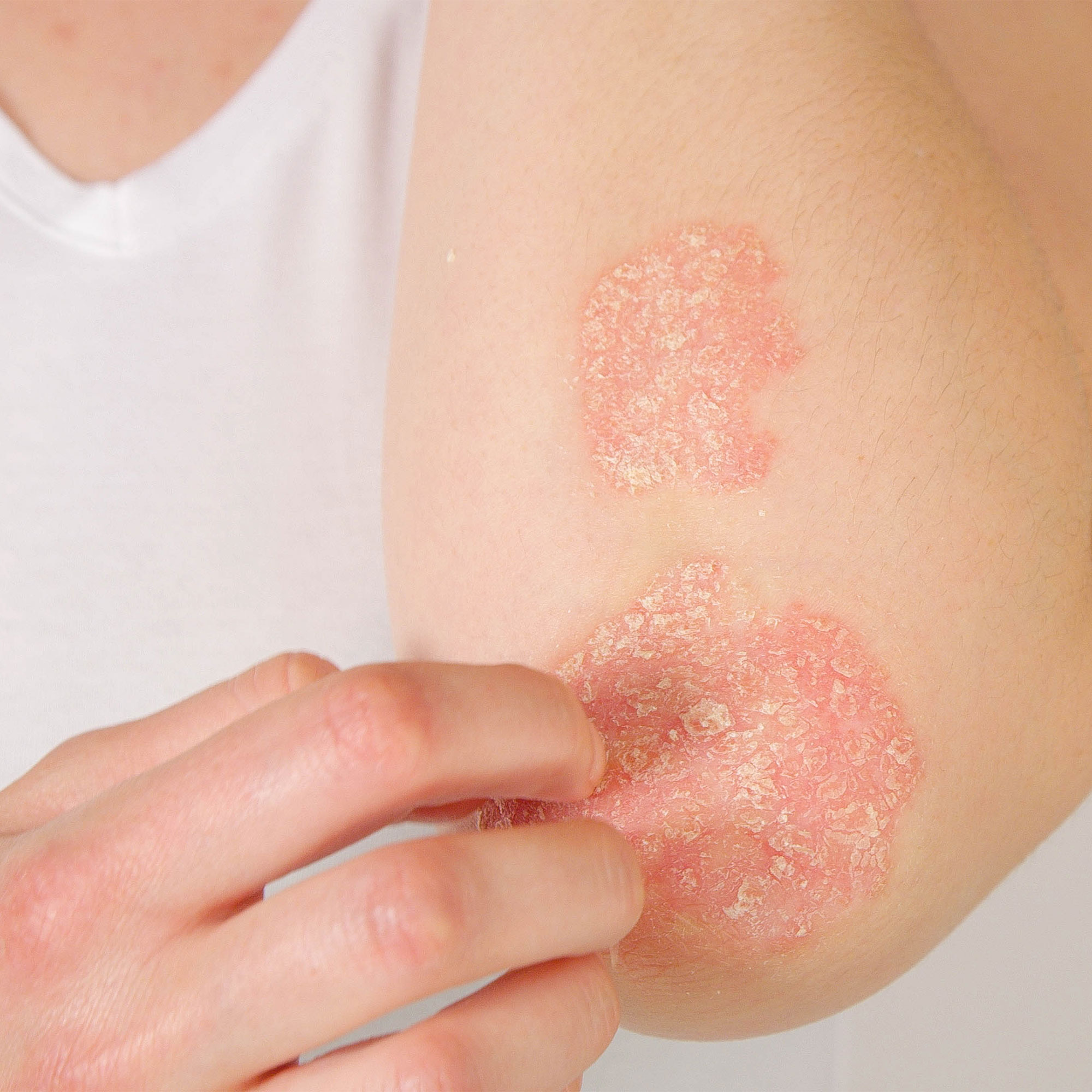 在女人的肘部上牛皮癣的视图