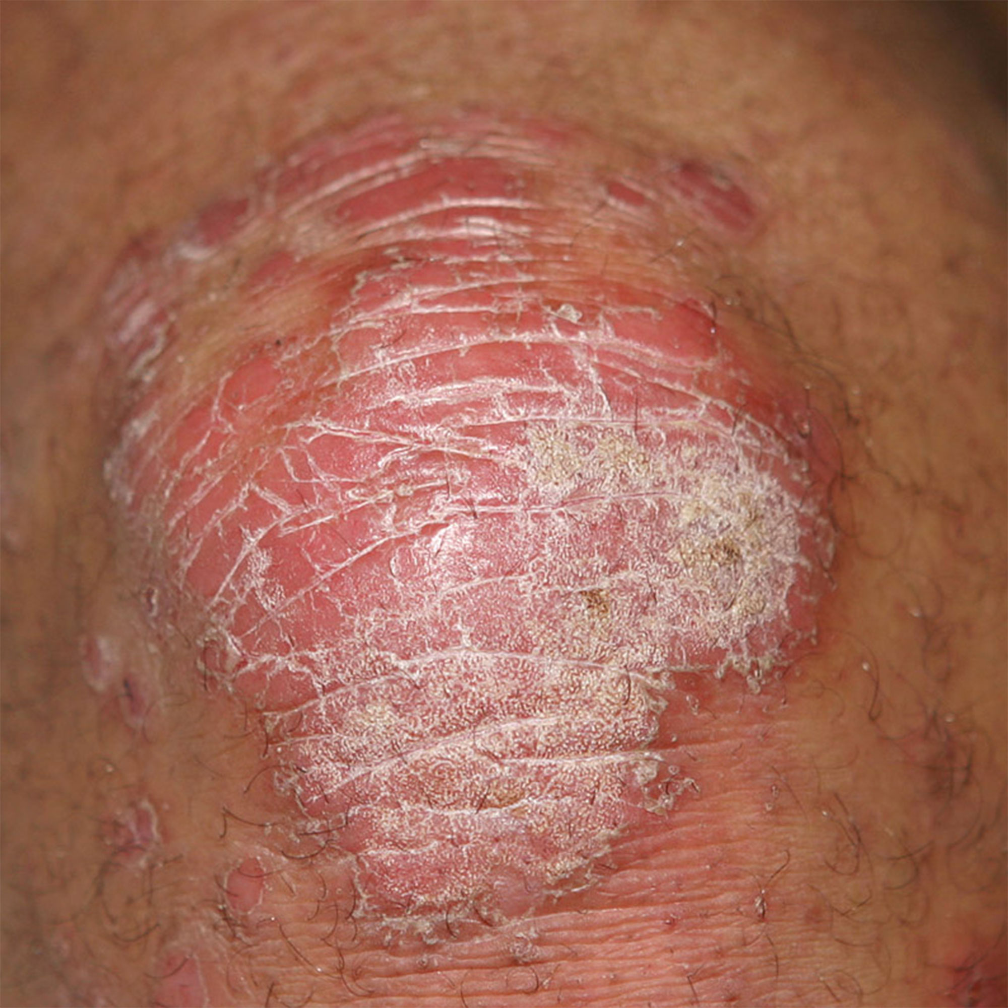 psoriasis knee