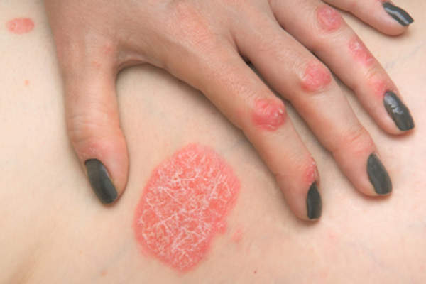 女性腿部和手指皮肤上的牛皮癣。